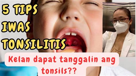 Tonsillitis sa mga Adulto.